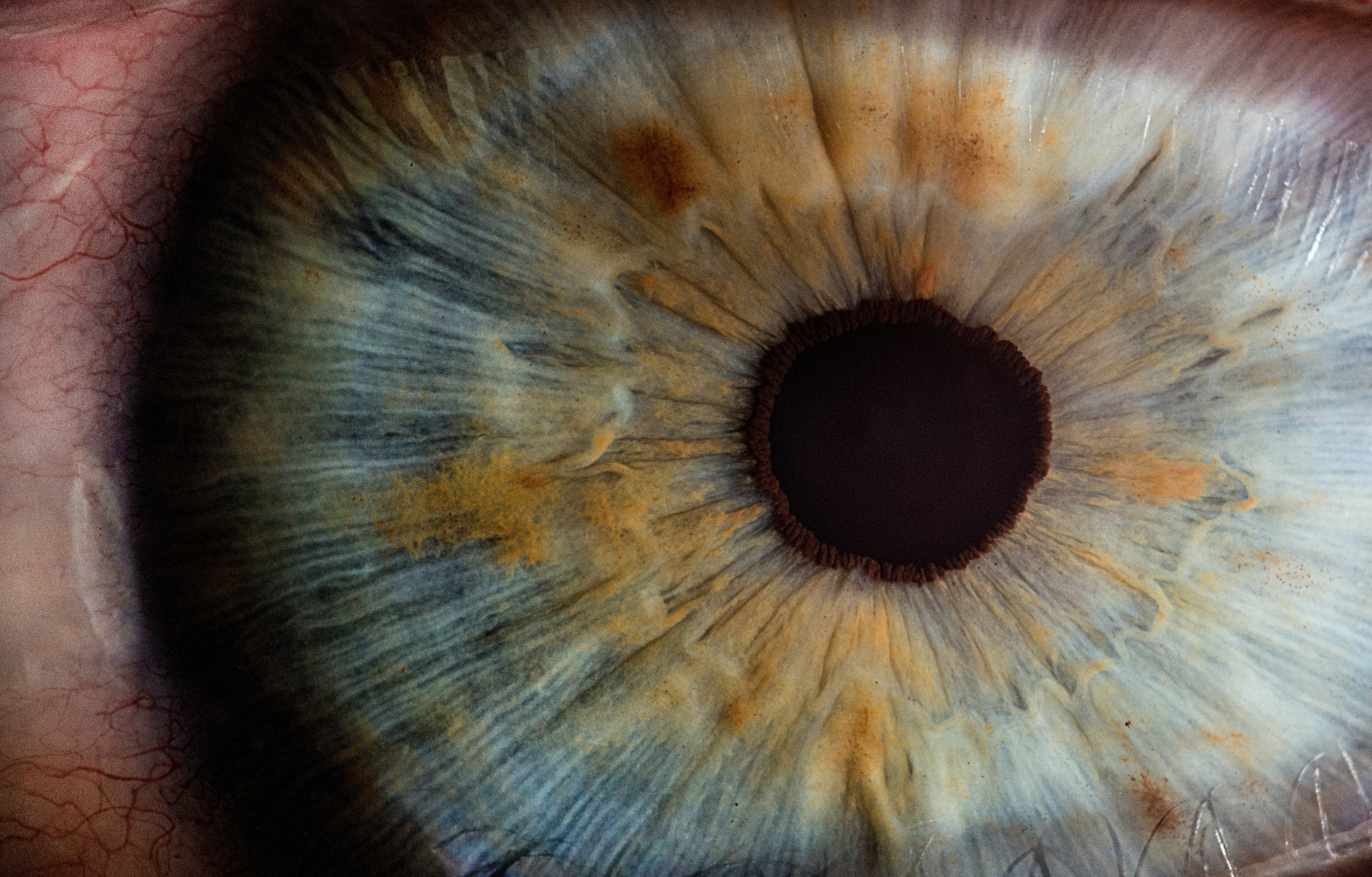 Lente de contacto innovadora para monitorear la presión intraocular: estudio piloto en humanos